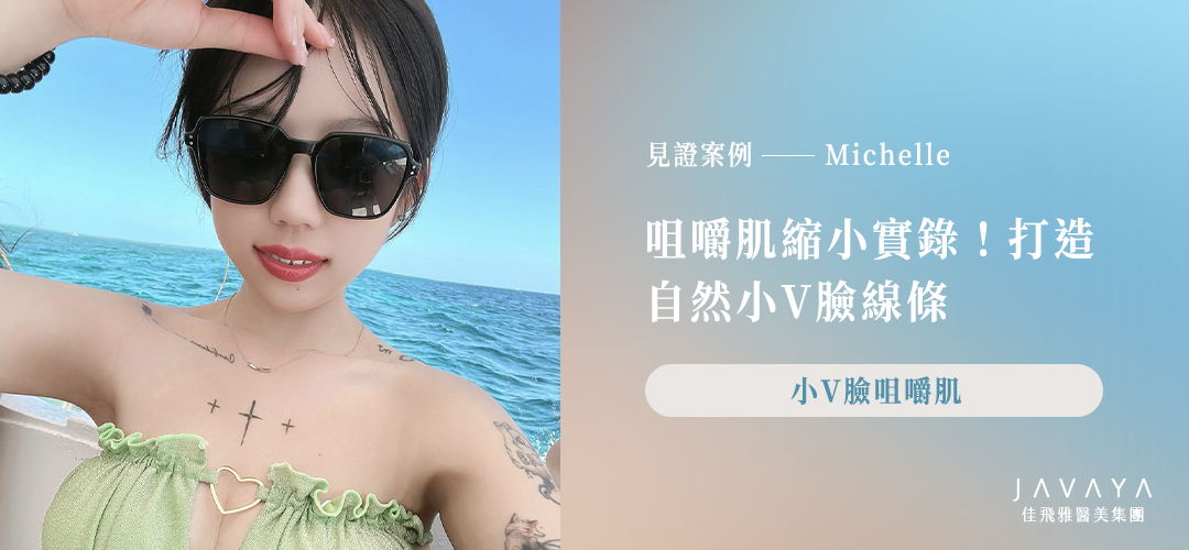 見證案例-Michelle|咀嚼肌縮小實錄!打造小V臉線條